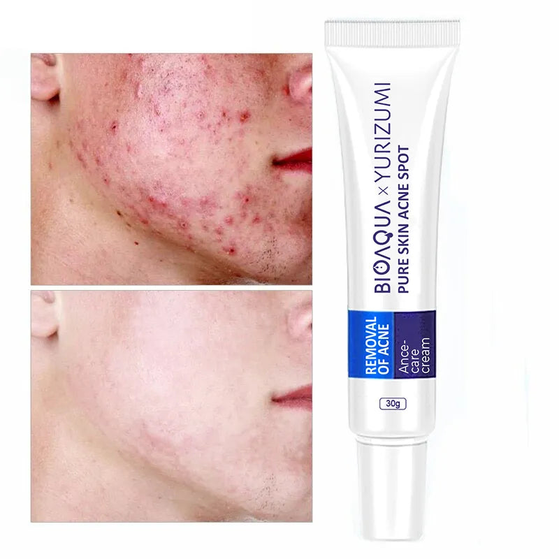 Pure Skin Acne Rejuvenation & Removal Cream – 30g