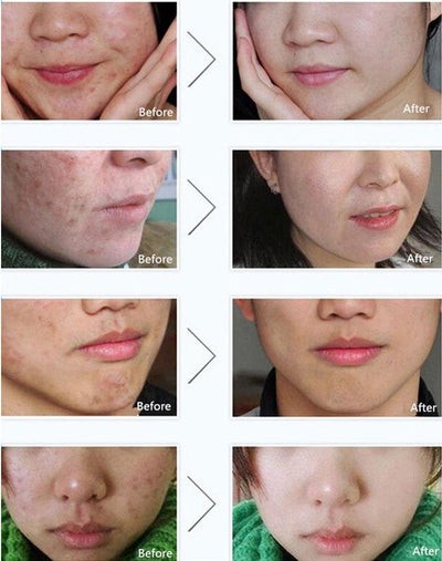 Pure Skin Acne Rejuvenation & Removal Cream – 30g