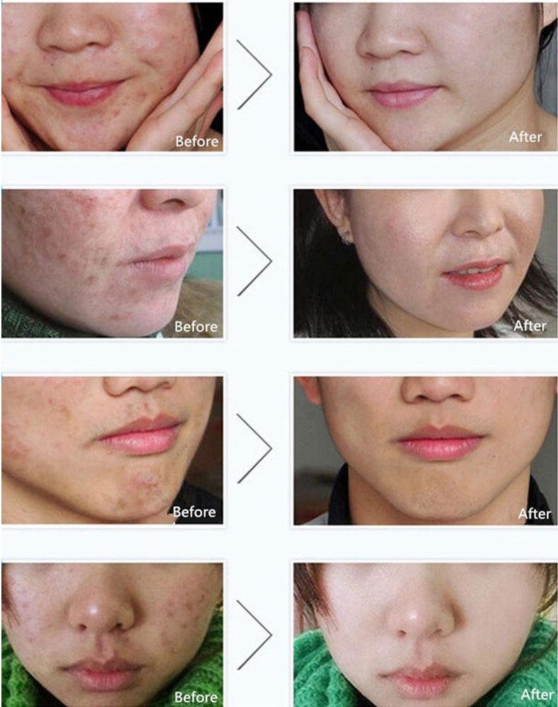 Pure Skin Acne Rejuvenation & Removal Cream – 30g