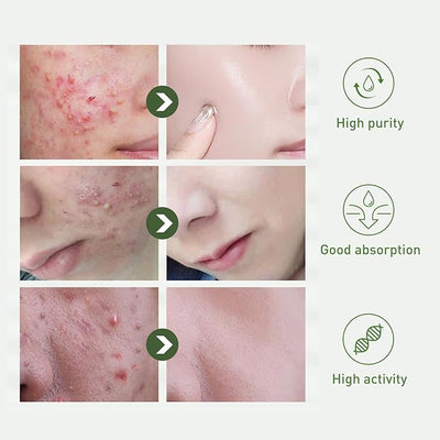 Tea Tree Extract Acne Treatment Serum 40ml for Acne & Pimple Repair